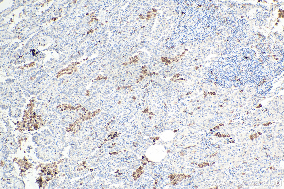 Immunohistochemistry (IHC) staining of human lung cancer tissue using CD68 Monoclonal antibody (66231-2-Ig)