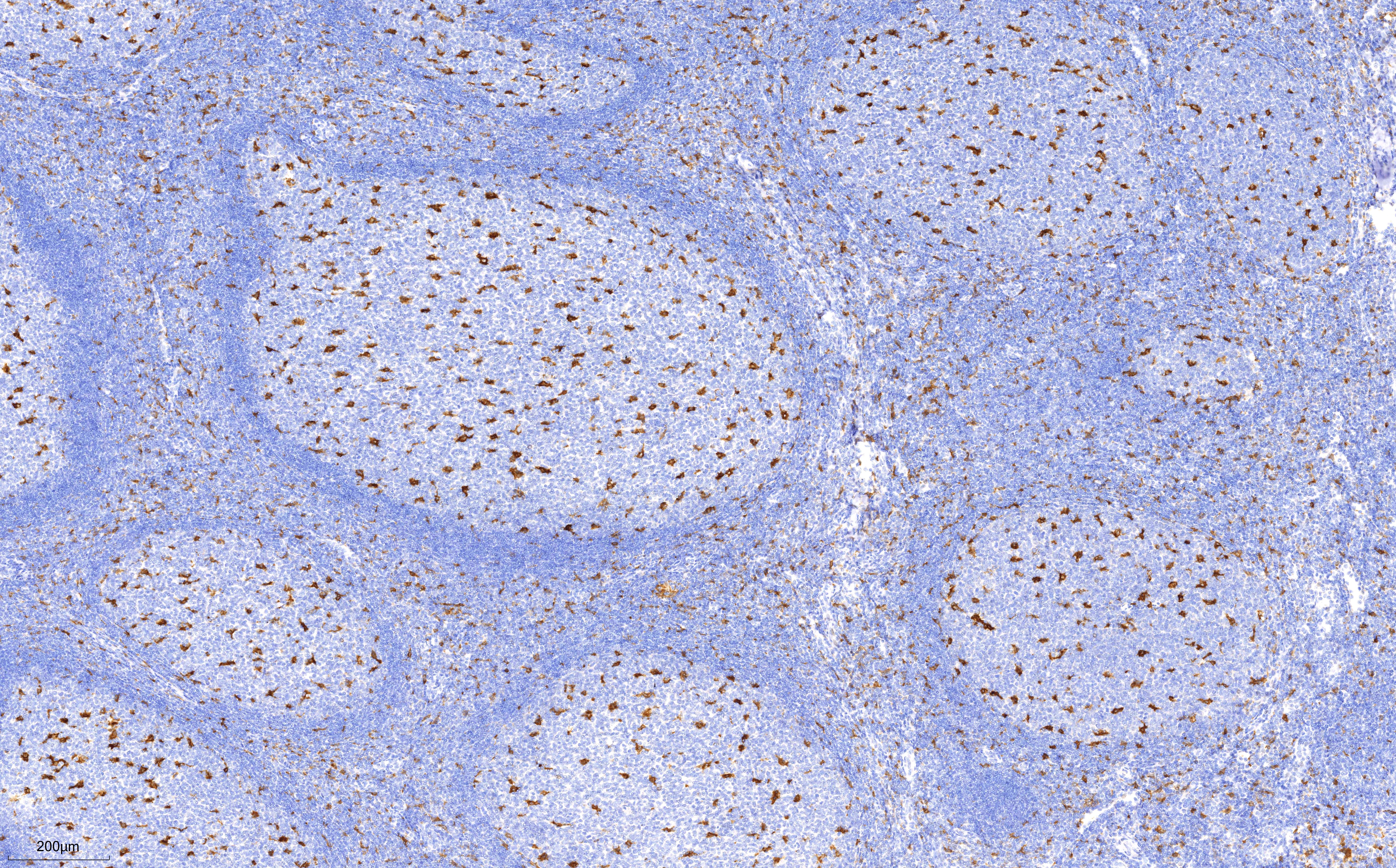 Immunohistochemistry (IHC) staining of human tonsillitis tissue using CD68 Monoclonal antibody (66231-2-Ig)