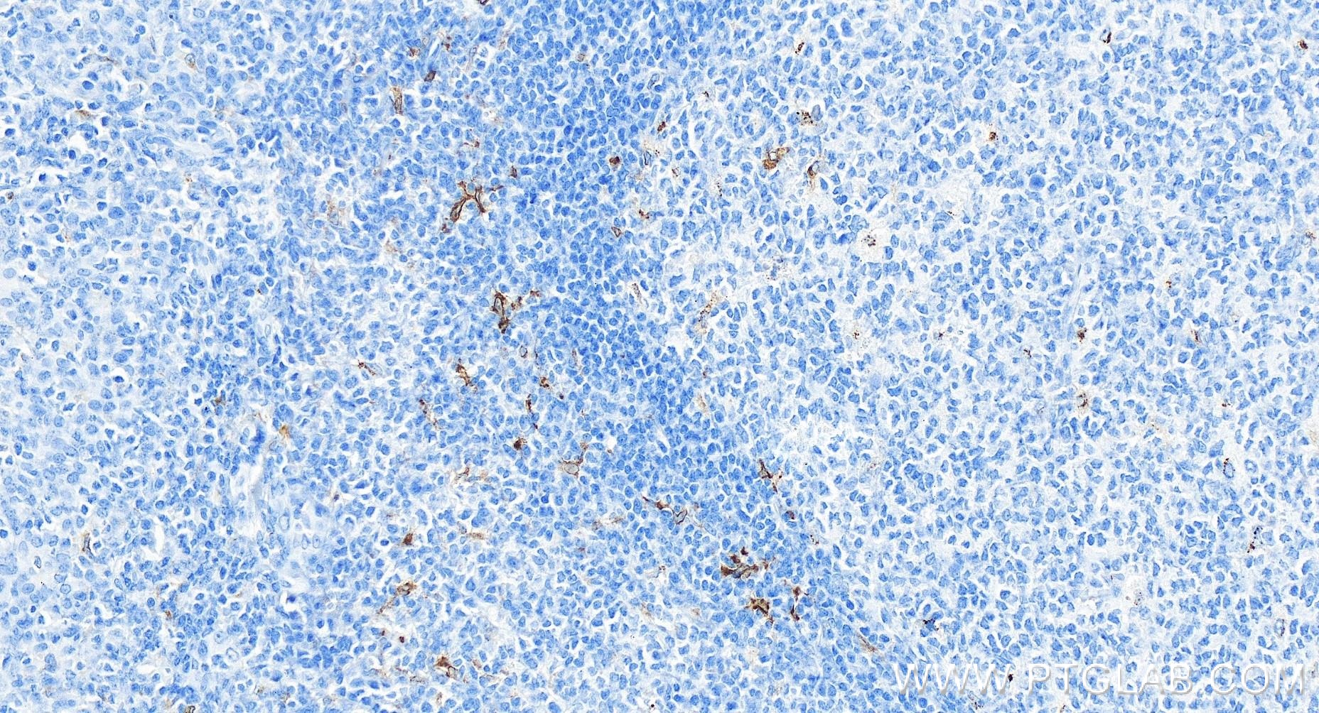 Immunohistochemistry (IHC) staining of human tonsillitis tissue using CD68 Recombinant antibody (84596-4-RR)