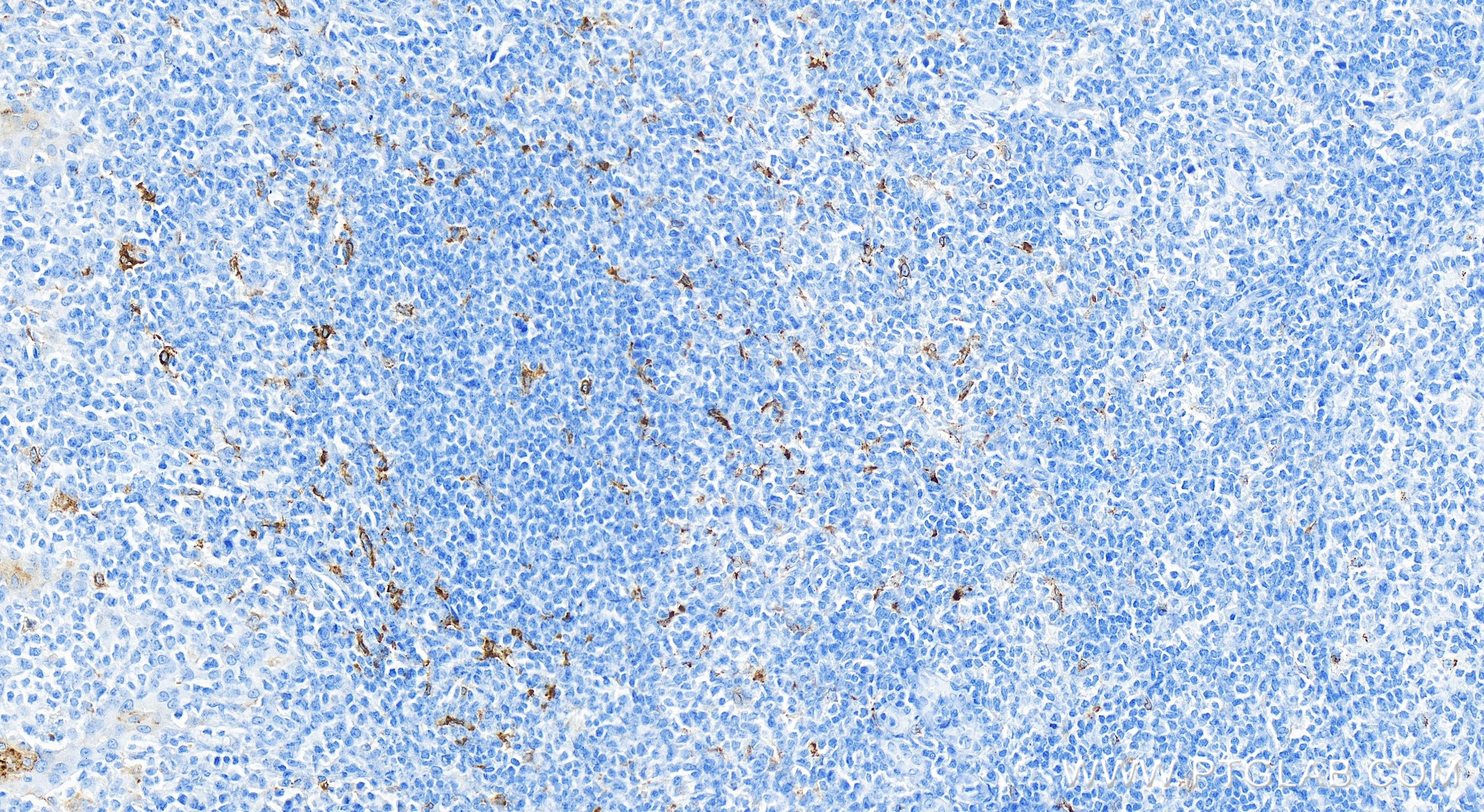 Immunohistochemistry (IHC) staining of human tonsillitis tissue using CD68 Recombinant antibody (84596-4-RR)