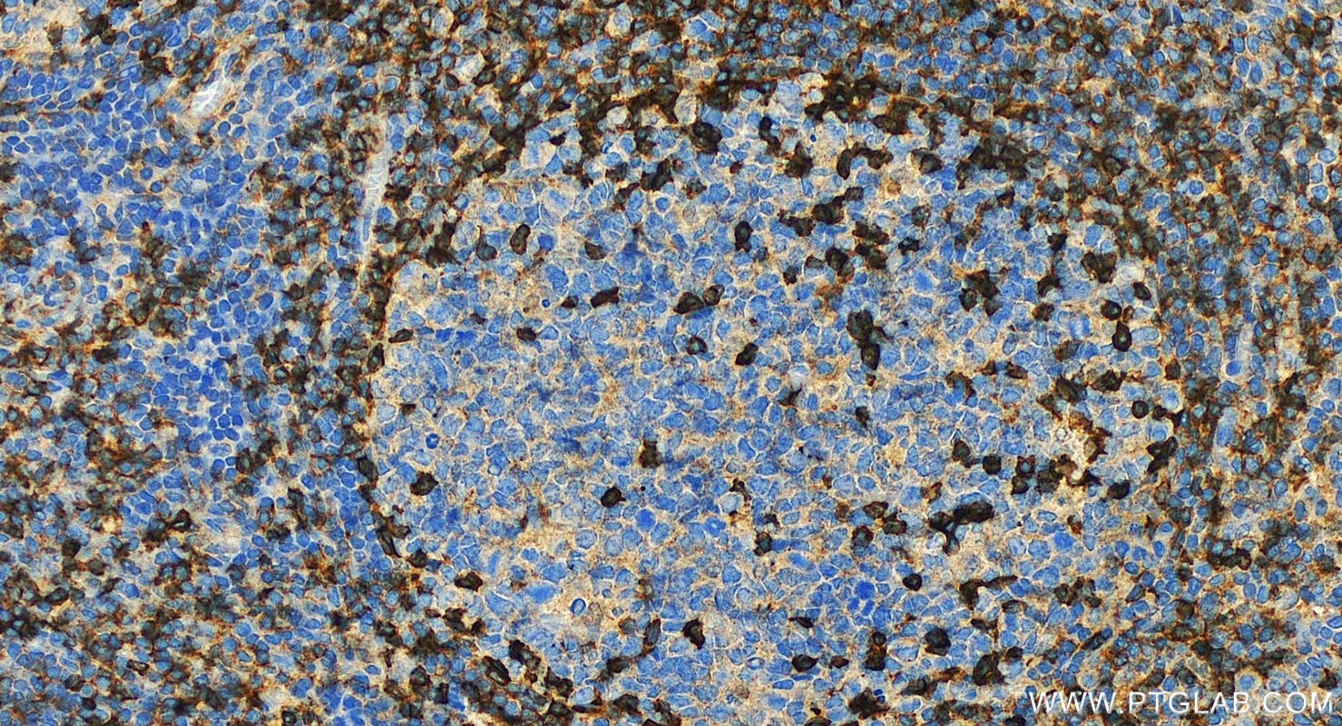 Immunohistochemistry (IHC) staining of human tonsillitis tissue using CD69 Polyclonal antibody (10803-1-AP)