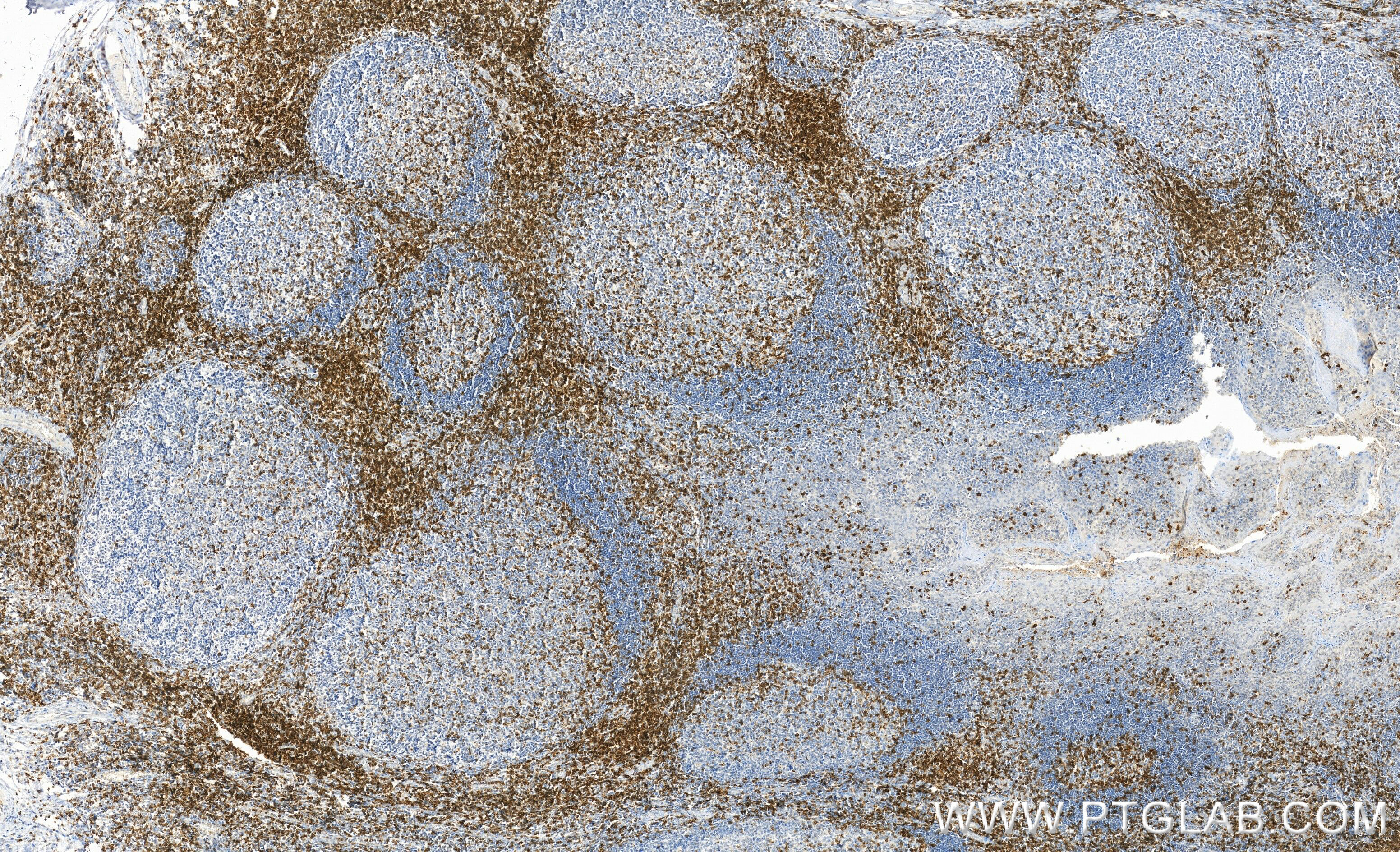 Immunohistochemistry (IHC) staining of human tonsillitis tissue using CD7 Monoclonal antibody (60209-2-Ig)