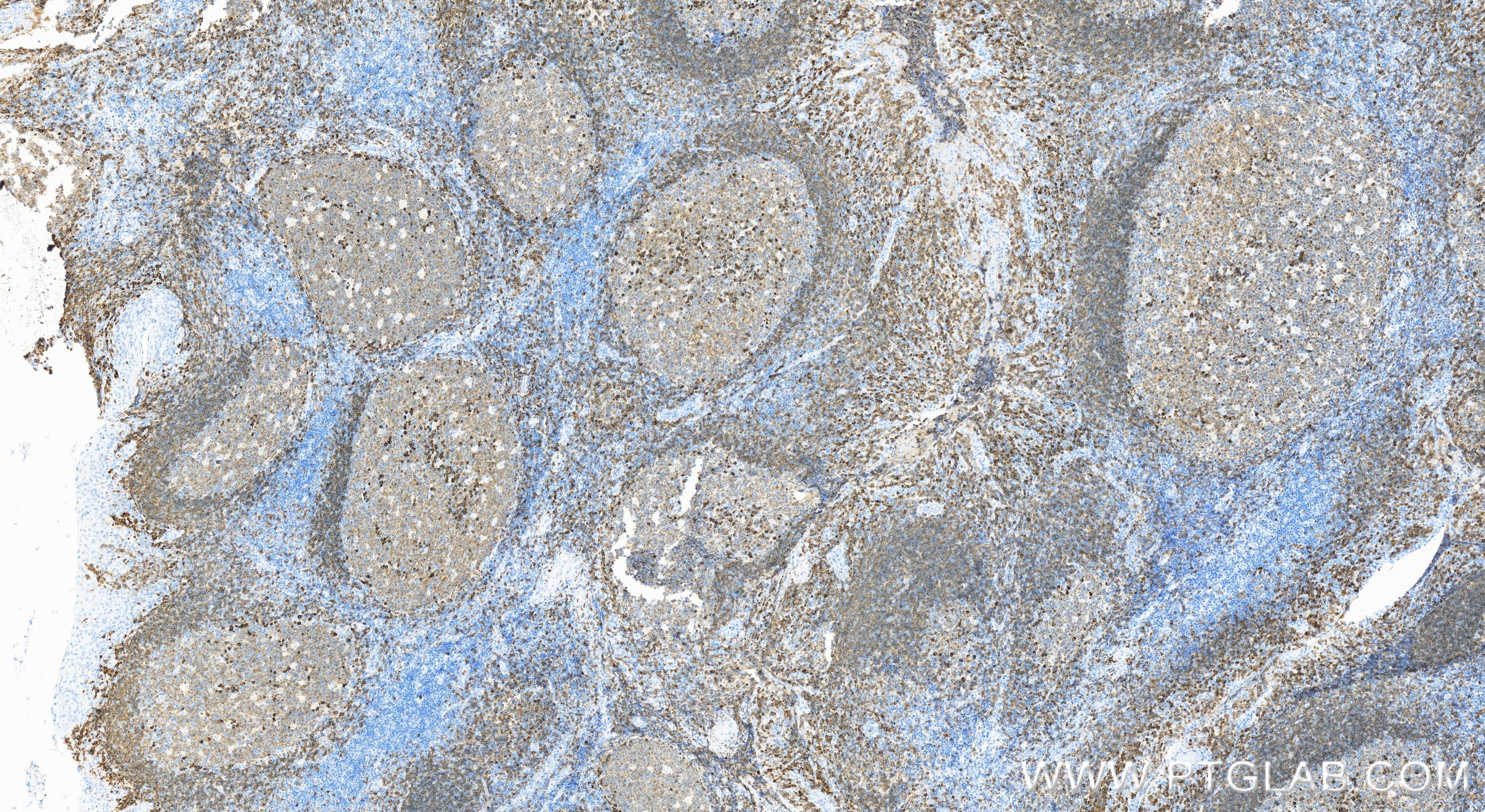 Immunohistochemistry (IHC) staining of human tonsillitis tissue using CD79a Recombinant antibody (84236-4-RR)