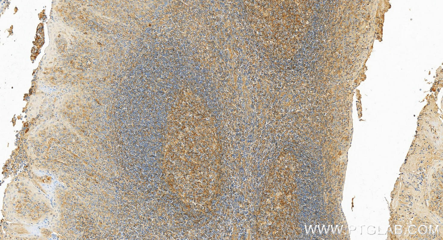 Immunohistochemistry (IHC) staining of human tonsillitis tissue using CD81 Polyclonal antibody (27855-1-AP)