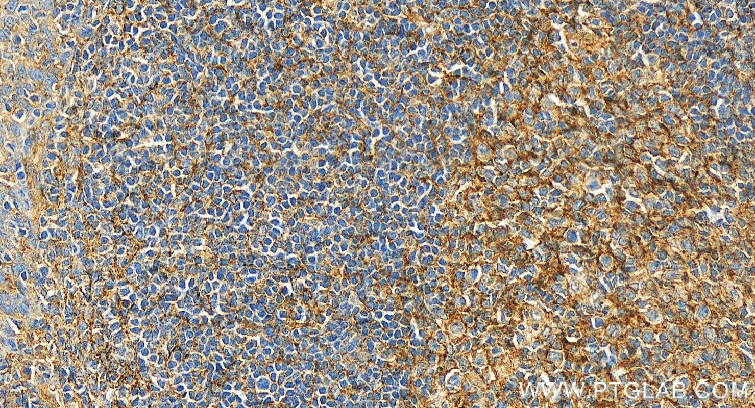 Immunohistochemistry (IHC) staining of human tonsillitis tissue using CD81 Polyclonal antibody (27855-1-AP)