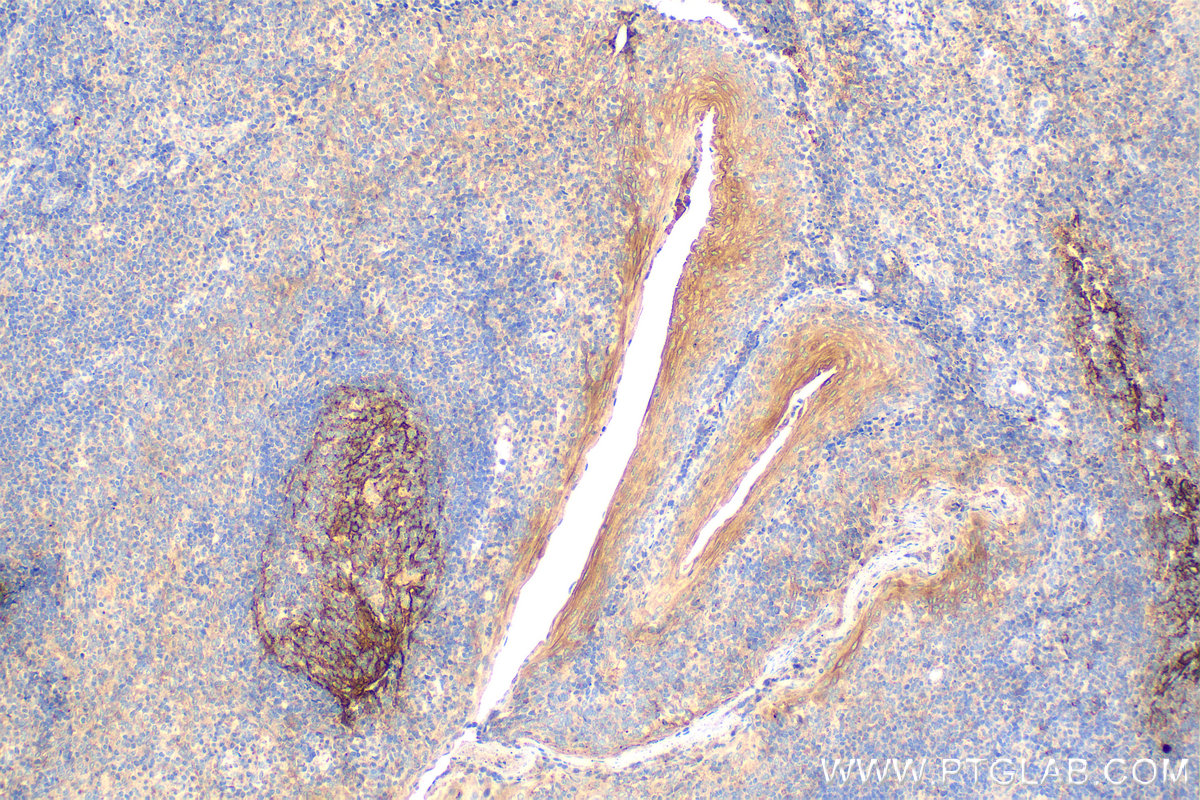 Immunohistochemistry (IHC) staining of human tonsillitis tissue using CD82 Monoclonal antibody (66803-1-Ig)