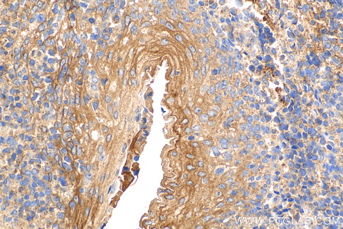 Immunohistochemistry (IHC) staining of human tonsillitis tissue using CD82 Monoclonal antibody (66803-1-Ig)