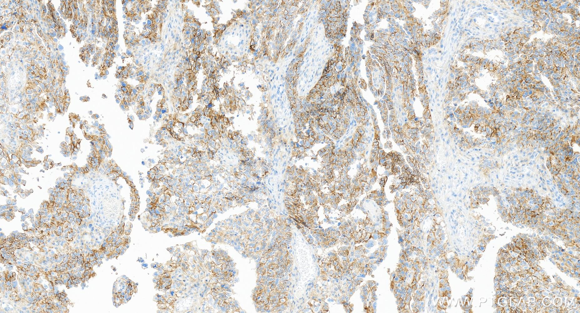 Immunohistochemistry (IHC) staining of human ovary cancer tissue using CD82 Recombinant antibody (84617-7-RR)