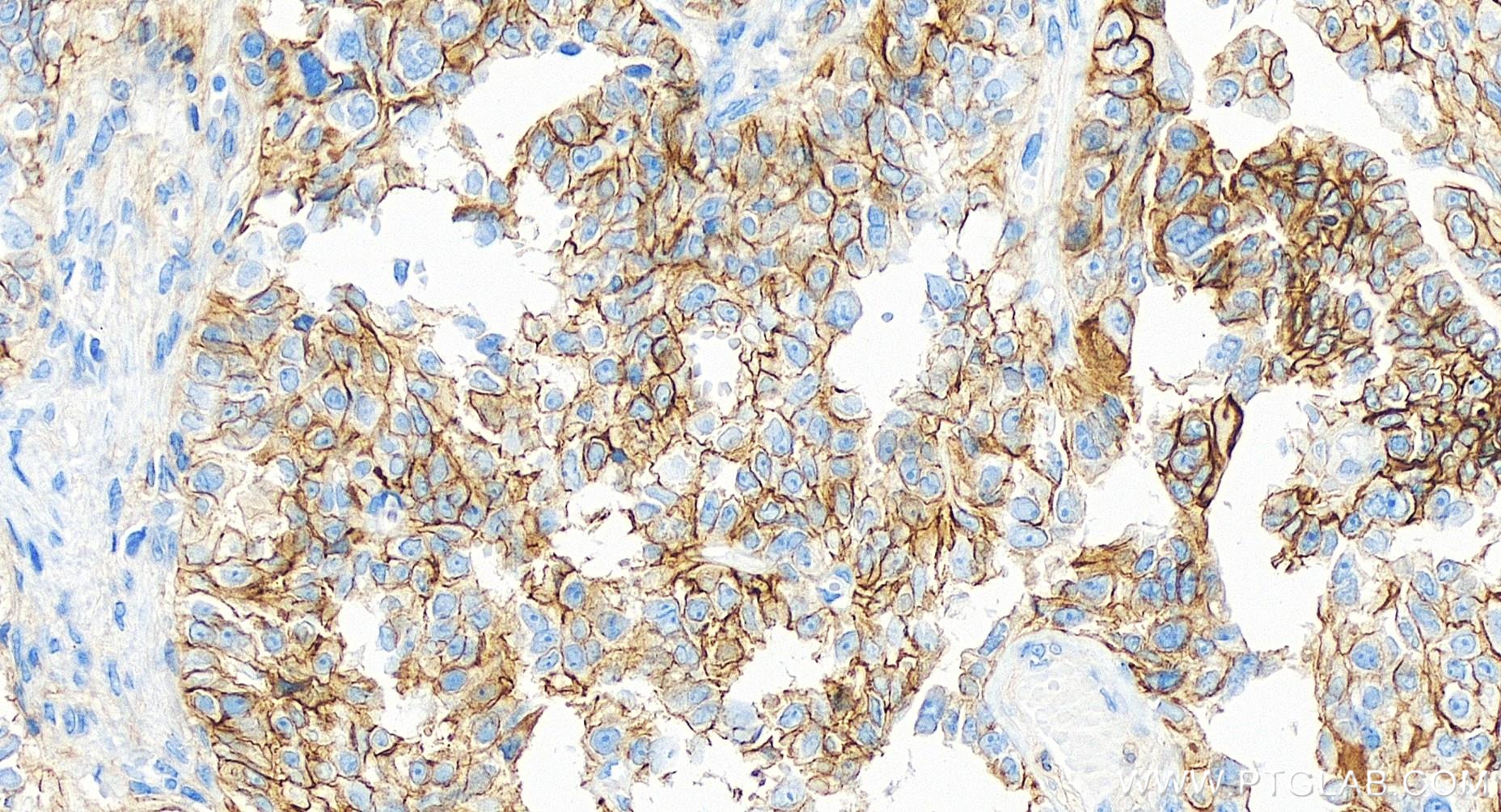 Immunohistochemistry (IHC) staining of human ovary cancer tissue using CD82 Recombinant antibody (84617-7-RR)