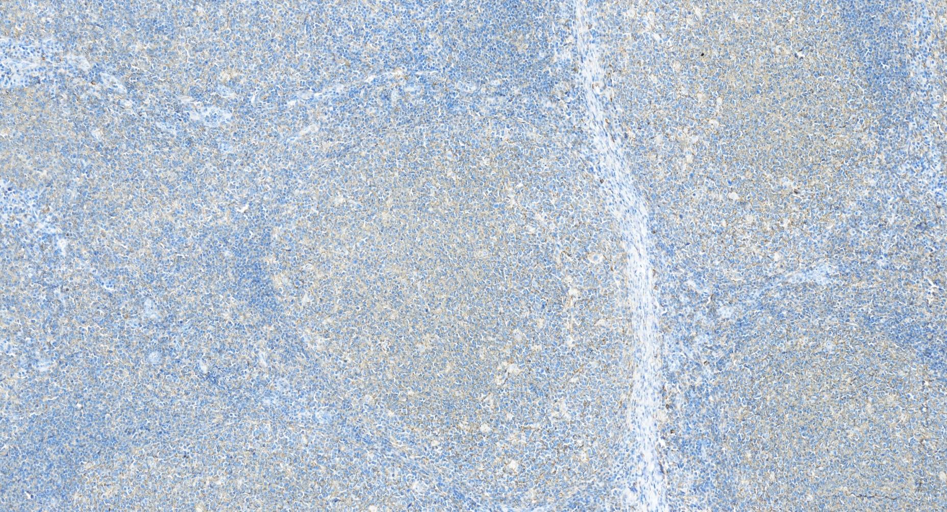 Immunohistochemistry (IHC) staining of human tonsillitis tissue using CD82 Recombinant antibody (84617-7-RR)