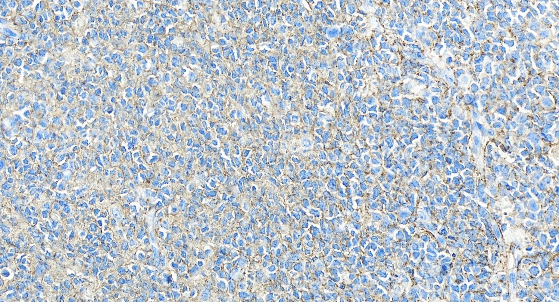 Immunohistochemistry (IHC) staining of human tonsillitis tissue using CD82 Recombinant antibody (84617-7-RR)