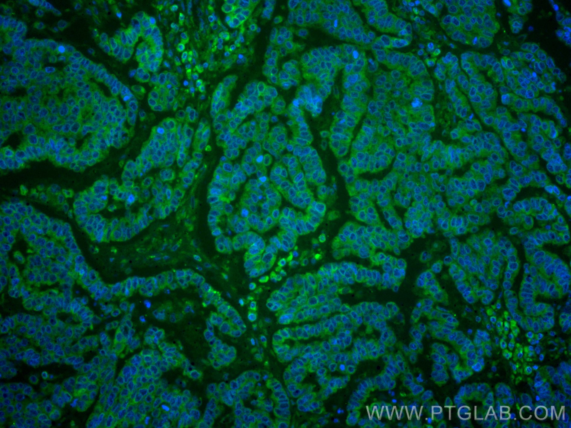 Immunofluorescence (IF) / fluorescent staining of human ovary tumor tissue using CoraLite® Plus 488-conjugated CD82 Monoclonal anti (CL488-66803)