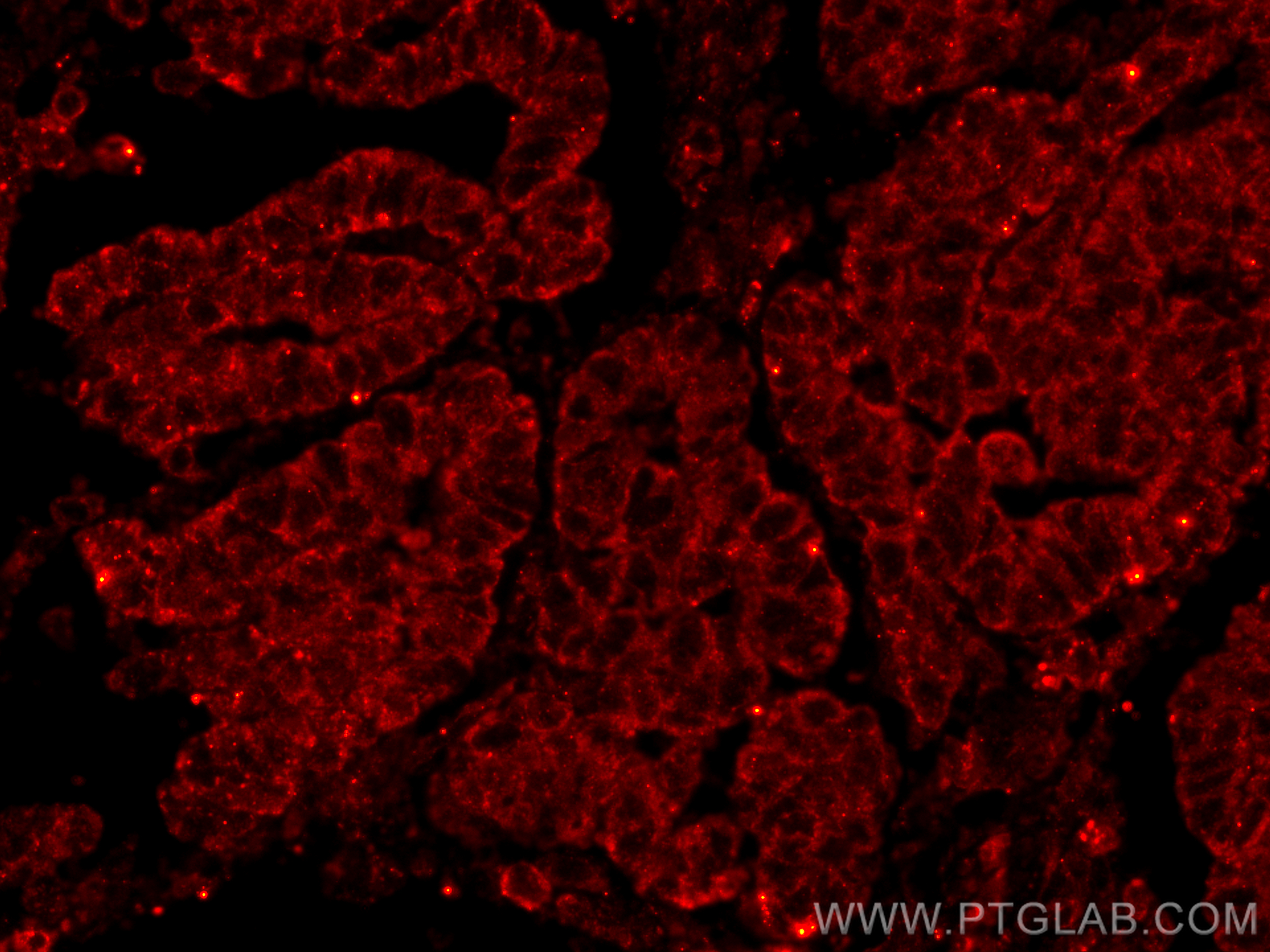 Immunofluorescence (IF) / fluorescent staining of human ovary tumor tissue using CoraLite®594-conjugated CD82 Monoclonal antibody (CL594-66803)