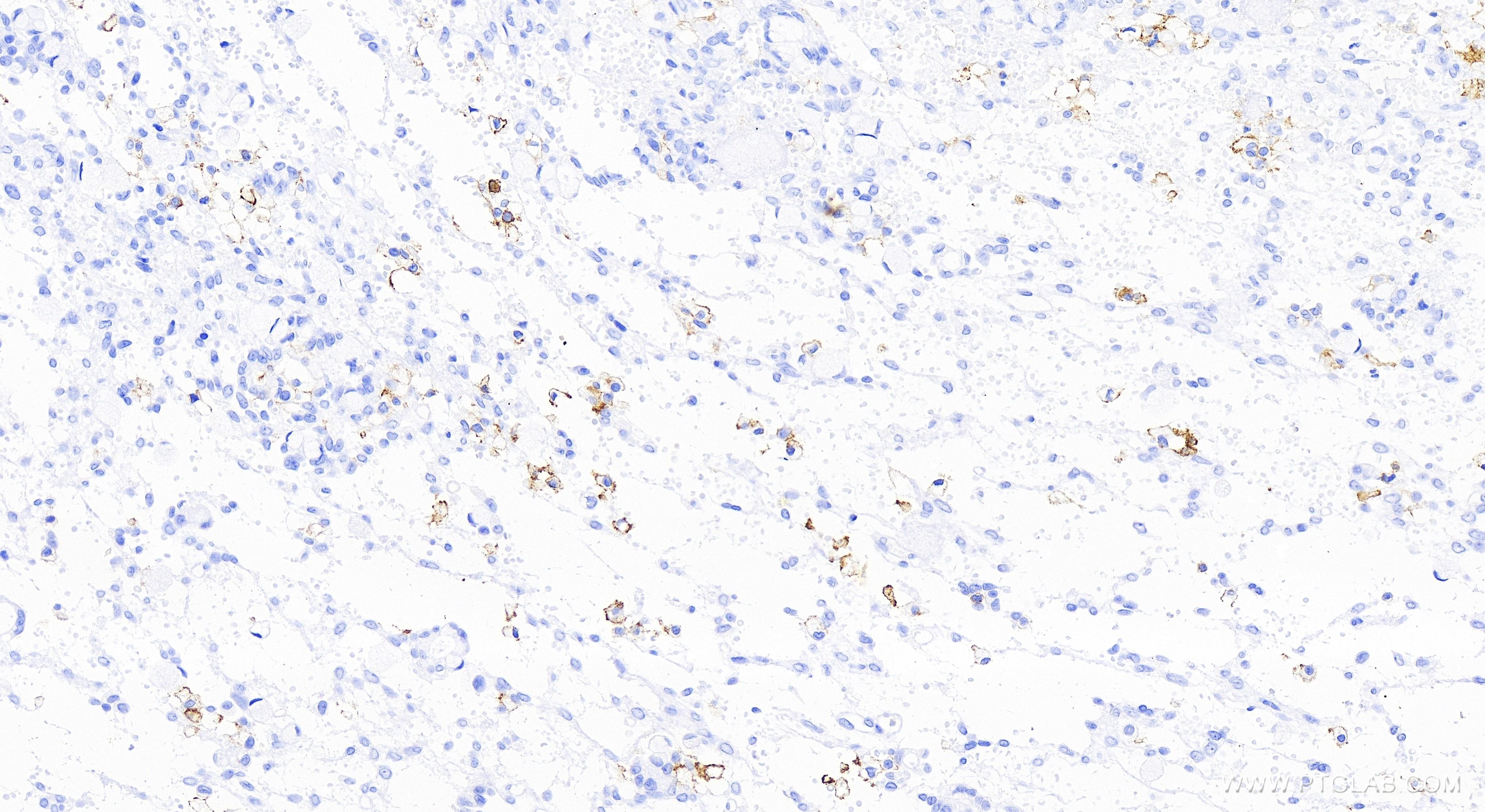 Immunohistochemistry (IHC) staining of human ovary cancer tissue using CD86 Recombinant antibody (83523-4-RR)