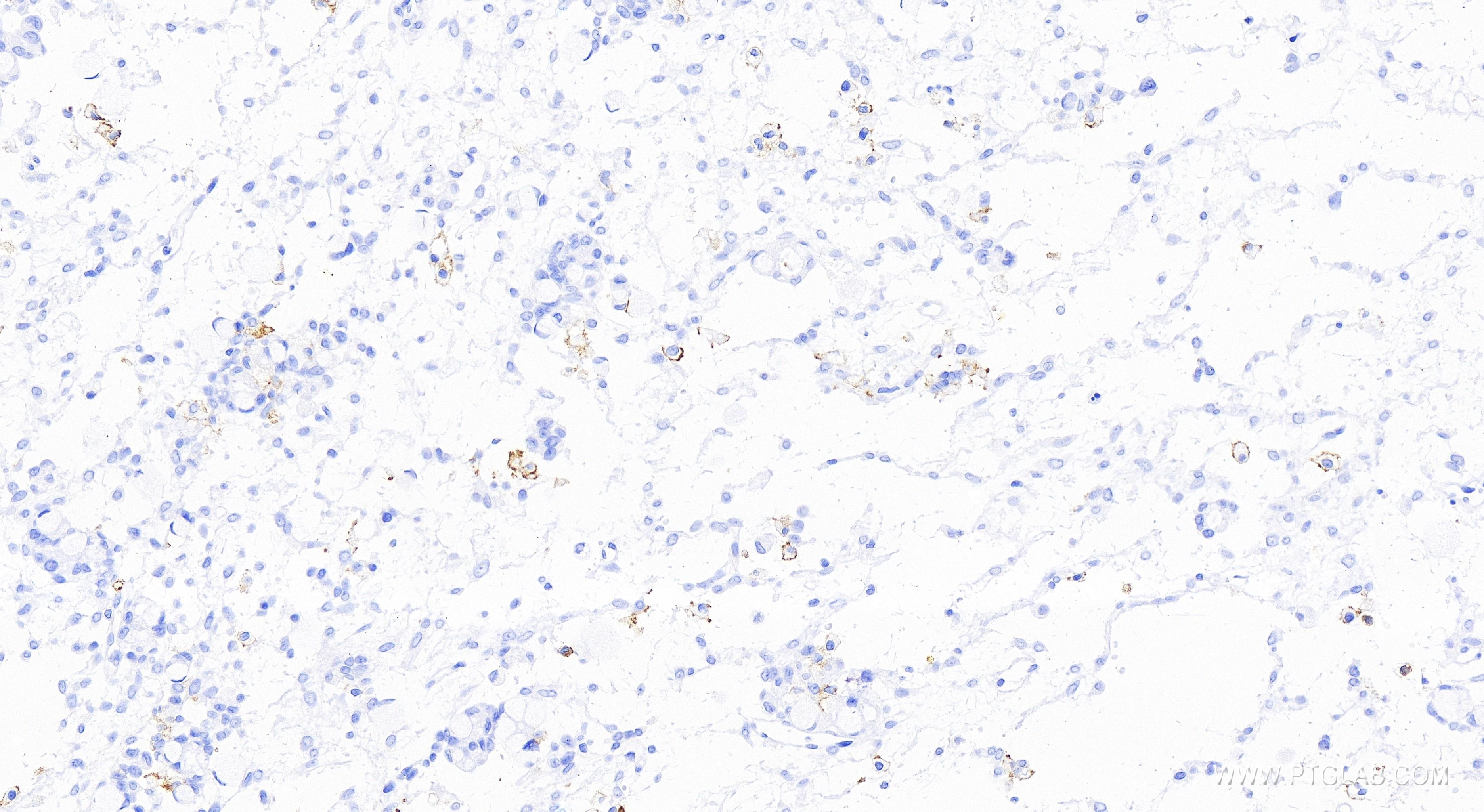 Immunohistochemistry (IHC) staining of human ovary cancer tissue using CD86 Recombinant antibody (83523-4-RR)