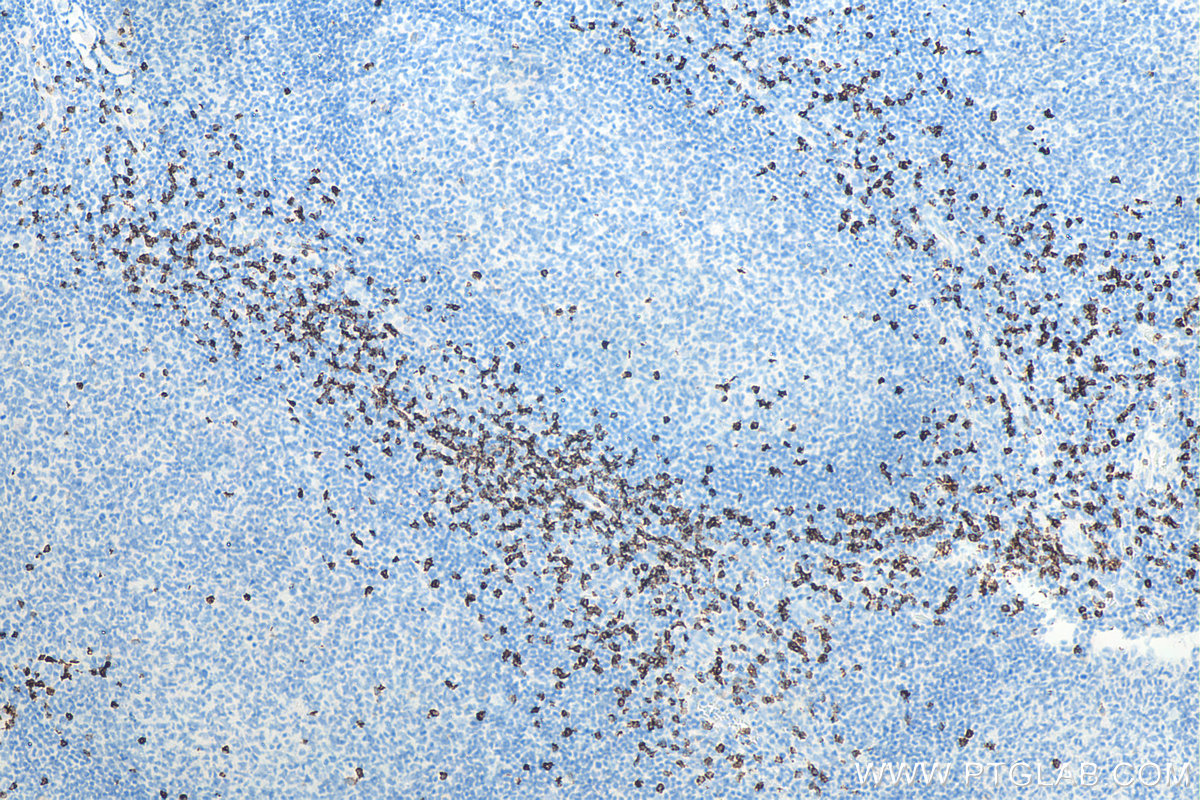 Immunohistochemistry (IHC) staining of human tonsillitis tissue using CD8a Monoclonal antibody (66868-1-Ig)