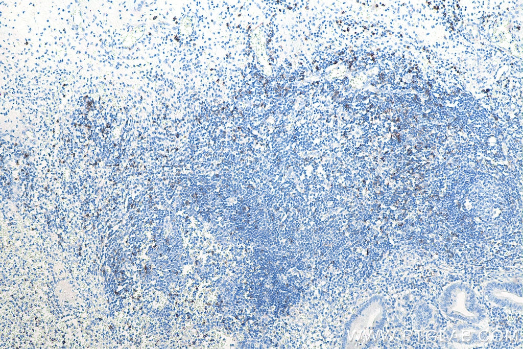 Immunohistochemistry (IHC) staining of human appendicitis tissue using CD8a Monoclonal antibody (66868-1-Ig)