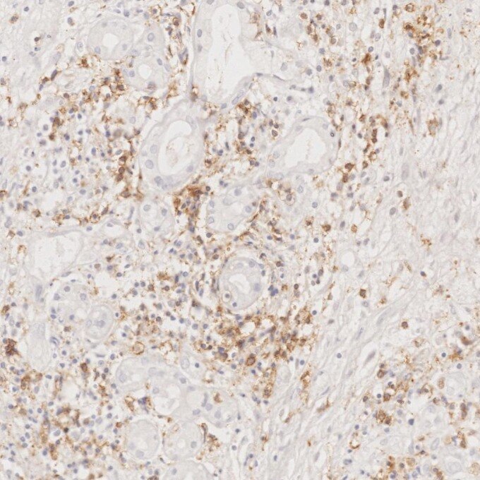 Immunohistochemistry (IHC) staining of human lymphoma tissue using CD8a Monoclonal antibody (66868-1-Ig)