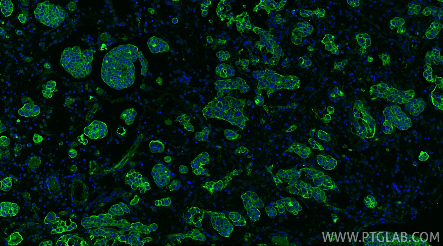 Immunofluorescence (IF) / fluorescent staining of human ovary cancer tissue using CD9 Polyclonal antibody (20597-1-AP)