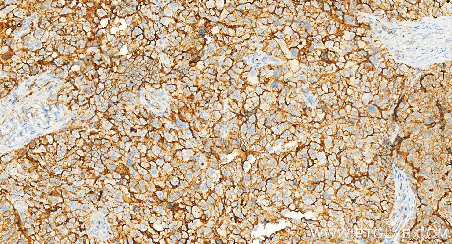 Immunohistochemistry (IHC) staining of human ovary cancer tissue using CD9 Polyclonal antibody (20597-1-AP)