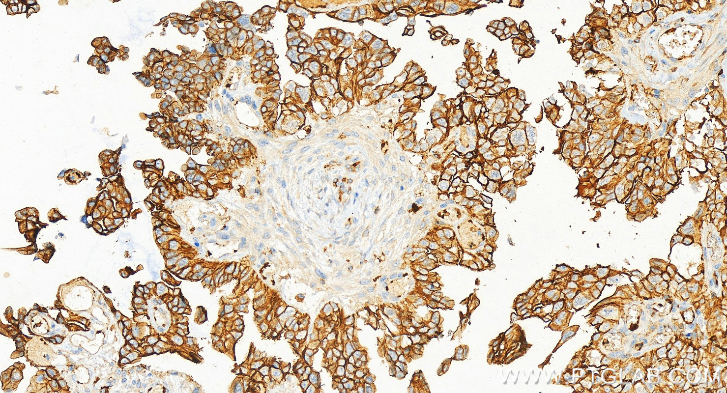 Immunohistochemistry (IHC) staining of human ovary cancer tissue using CD9 Polyclonal antibody (20597-1-AP)