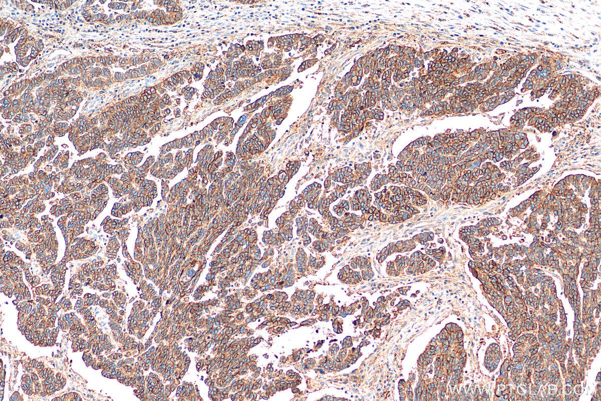 Immunohistochemistry (IHC) staining of human ovary tumor tissue using CD9 Monoclonal antibody (60232-1-Ig)