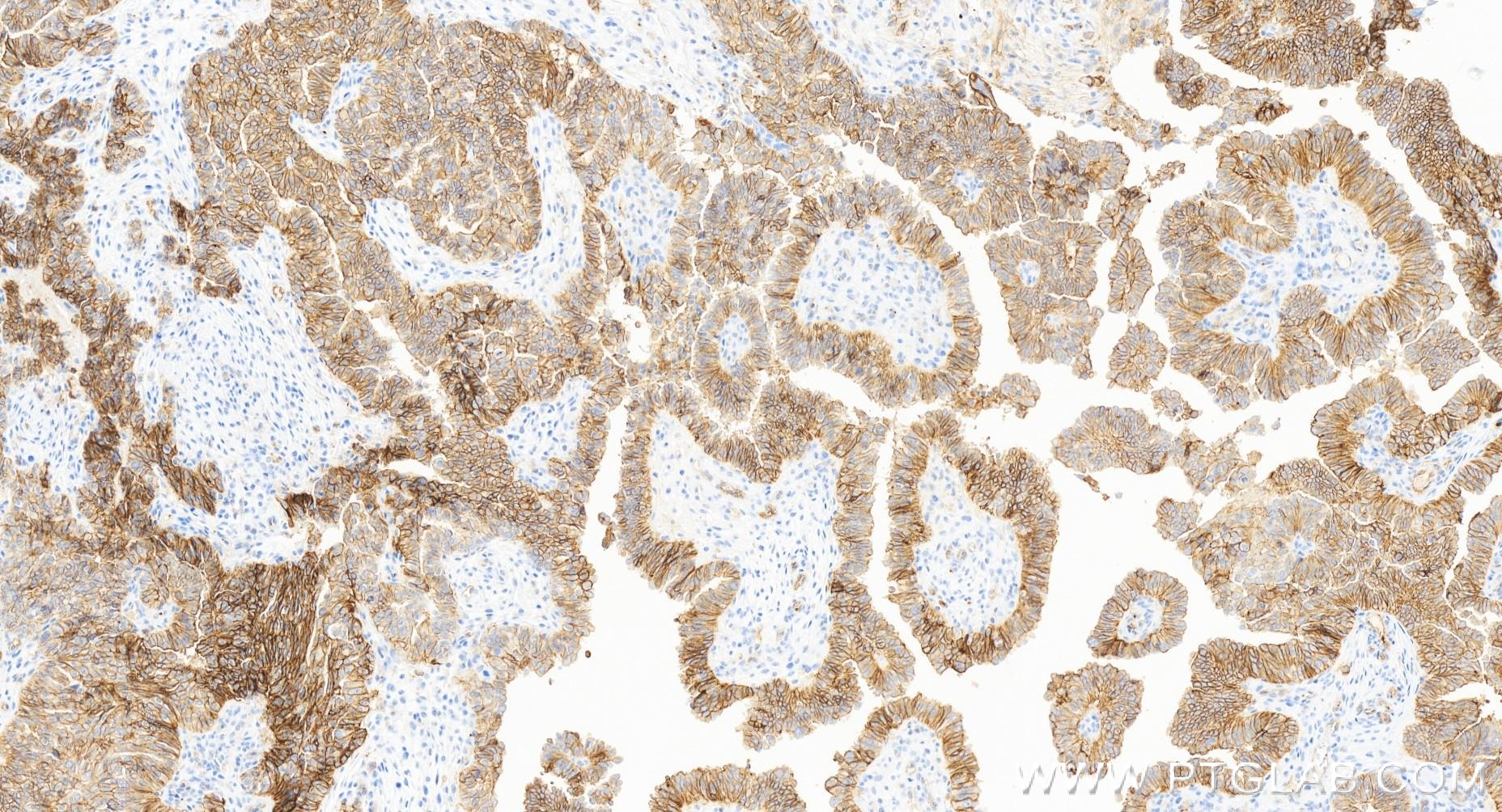 Immunohistochemistry (IHC) staining of human ovary cancer tissue using CD9 Recombinant antibody (84142-1-RR)