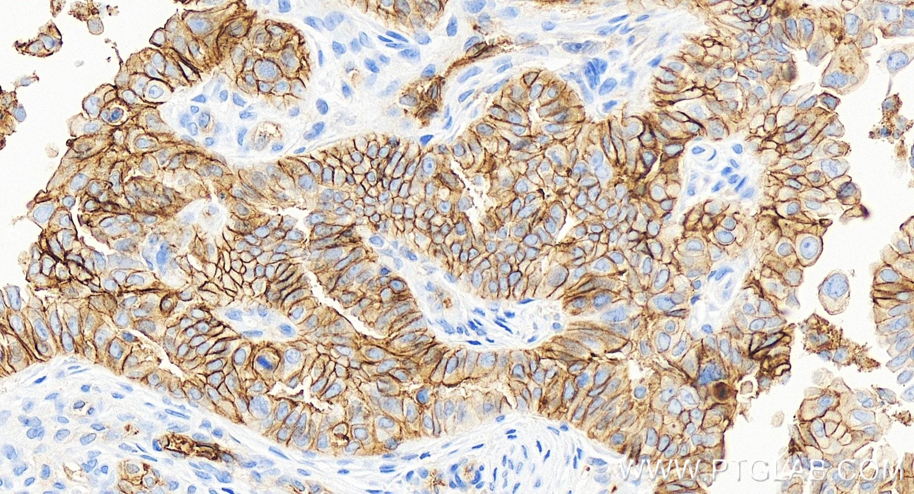 Immunohistochemistry (IHC) staining of human ovary cancer tissue using CD9 Recombinant antibody (84142-1-RR)