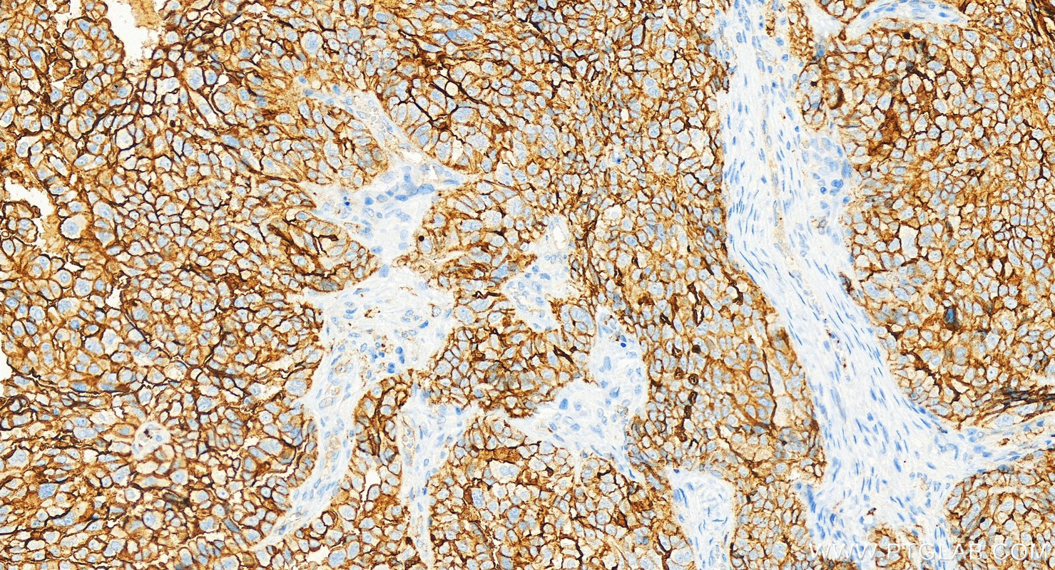 Immunohistochemistry (IHC) staining of human ovary cancer tissue using Multi-rAb™ CD9 Multi-Recombinant antibody (RMX00018)