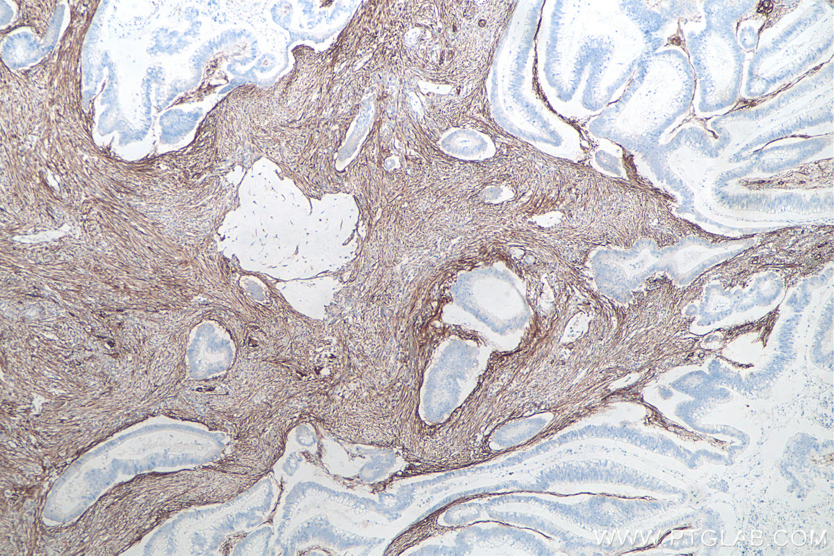 Immunohistochemistry (IHC) staining of human colon cancer tissue using CD90 Monoclonal antibody (66766-1-Ig)