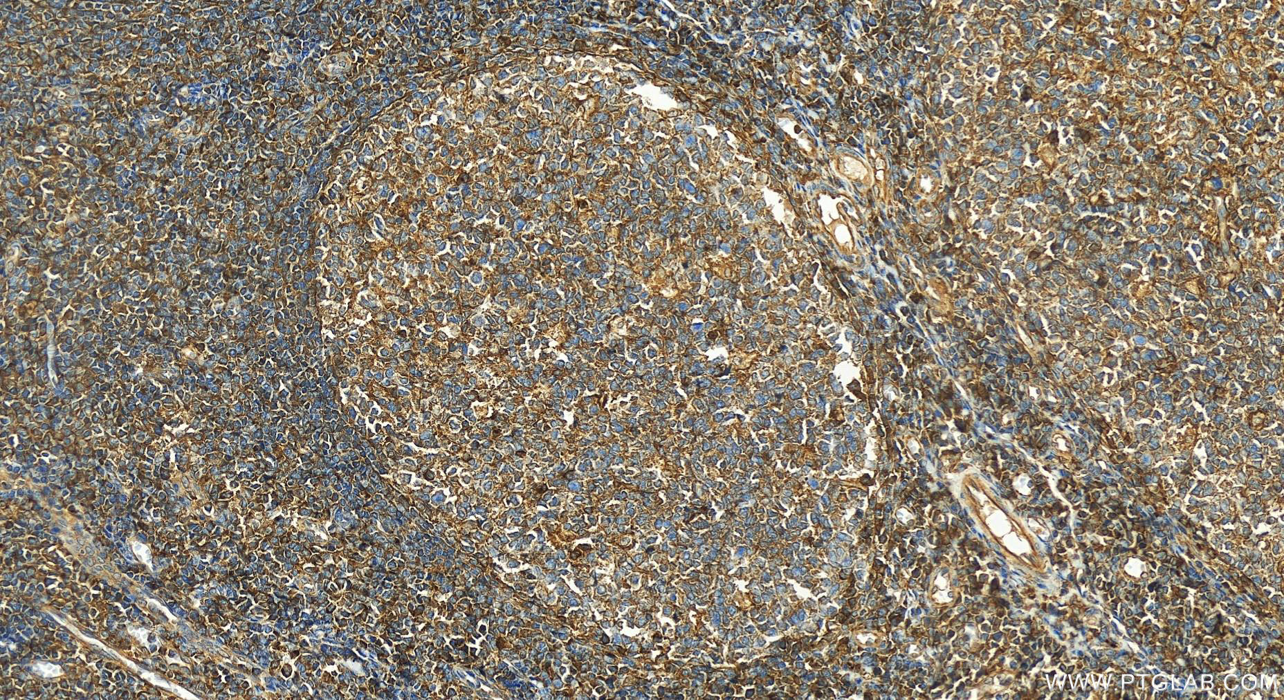 Immunohistochemistry (IHC) staining of human tonsillitis tissue using CD97 Polyclonal antibody (13071-1-AP)