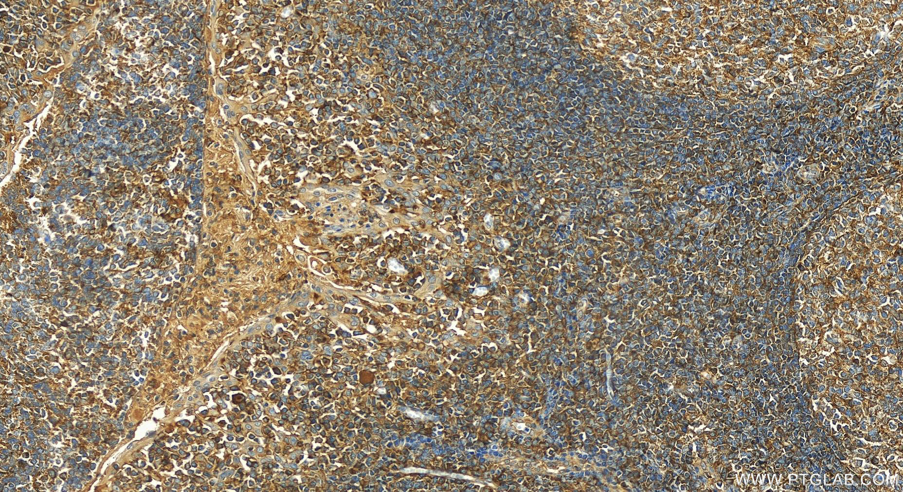 Immunohistochemistry (IHC) staining of human tonsillitis tissue using CD97 Polyclonal antibody (13071-1-AP)