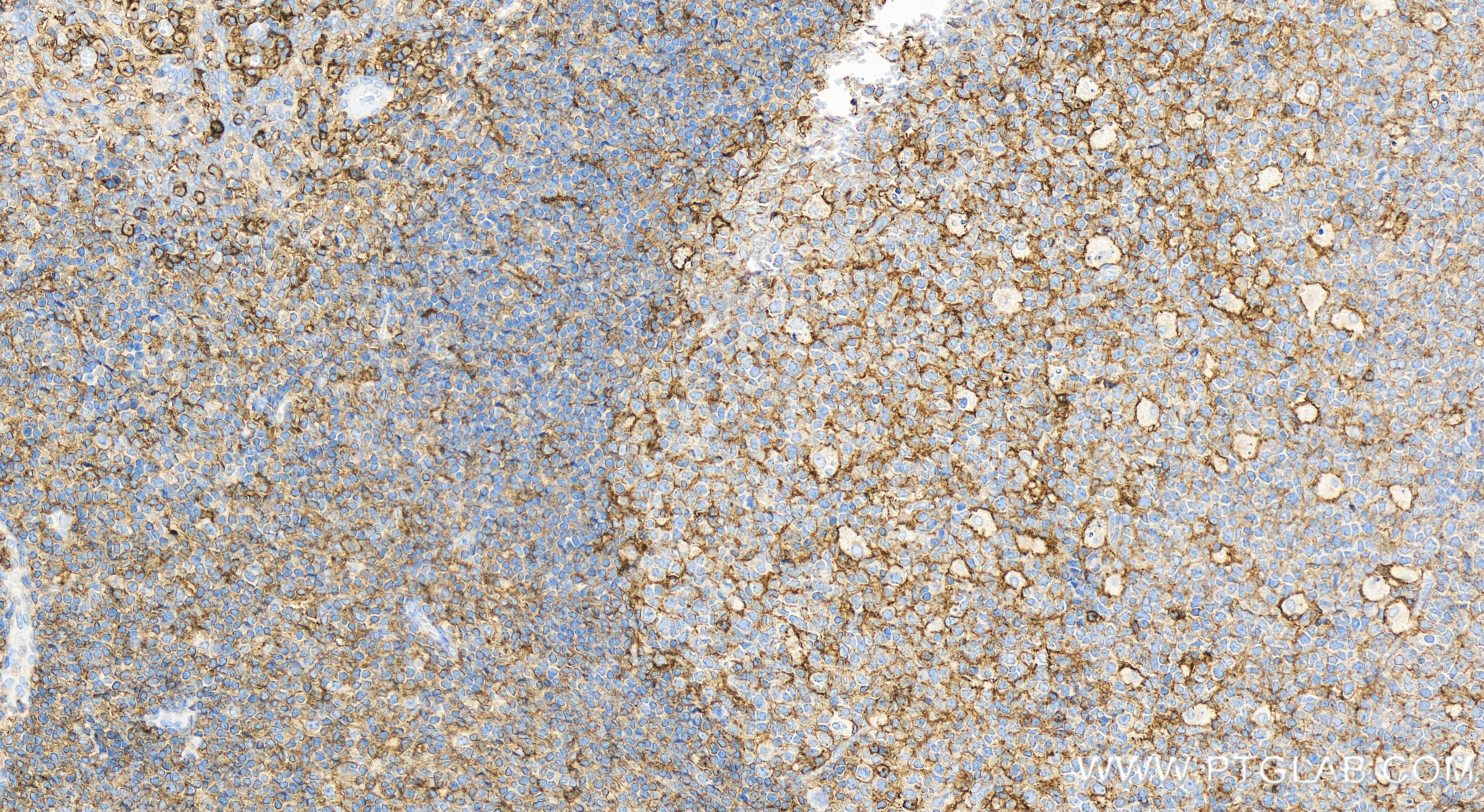 Immunohistochemistry (IHC) staining of human tonsillitis tissue using CD97 Recombinant antibody (84255-6-RR)