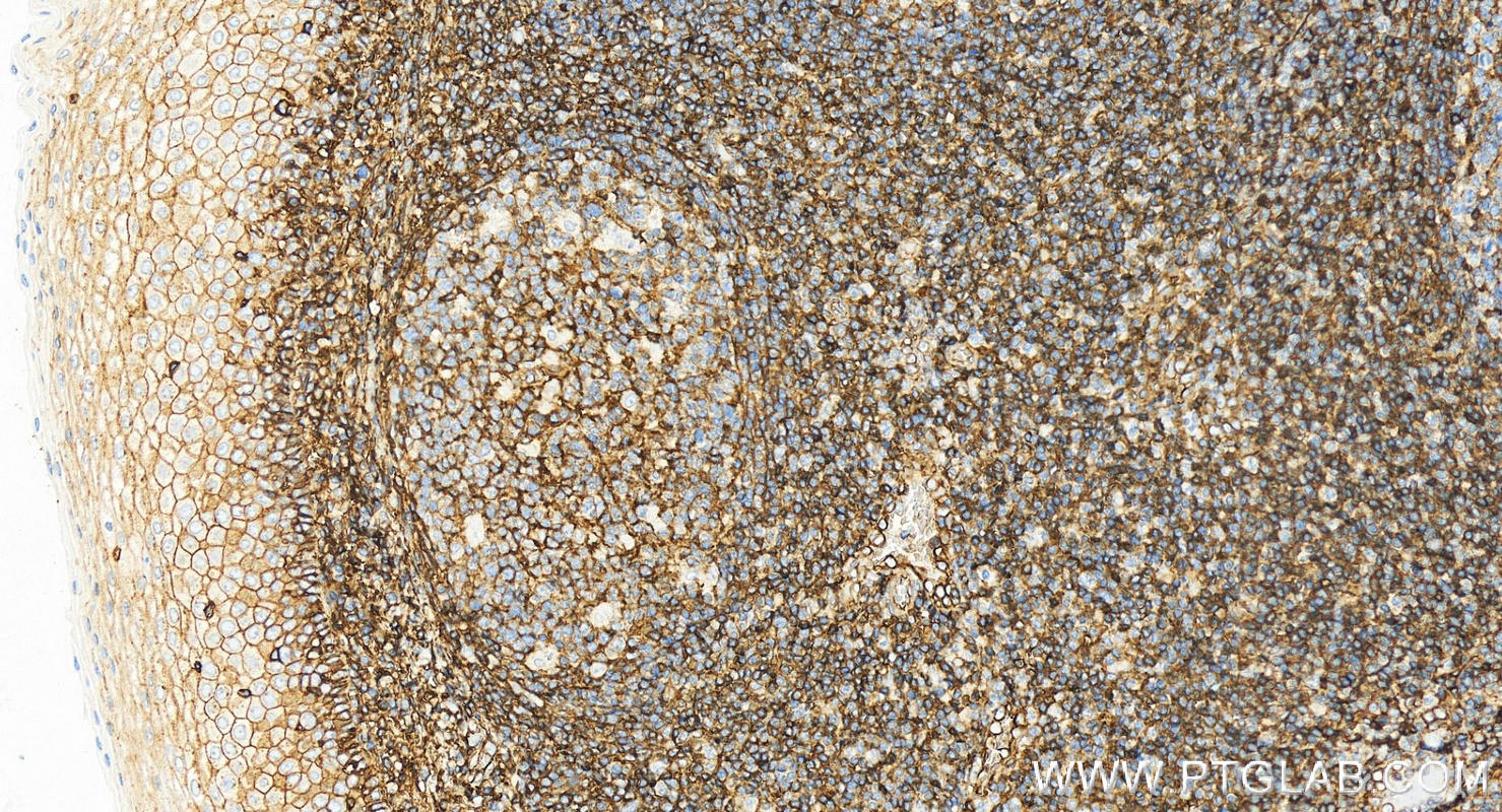 Immunohistochemistry (IHC) staining of human tonsillitis tissue using CD99 Recombinant antibody (84580-4-RR)