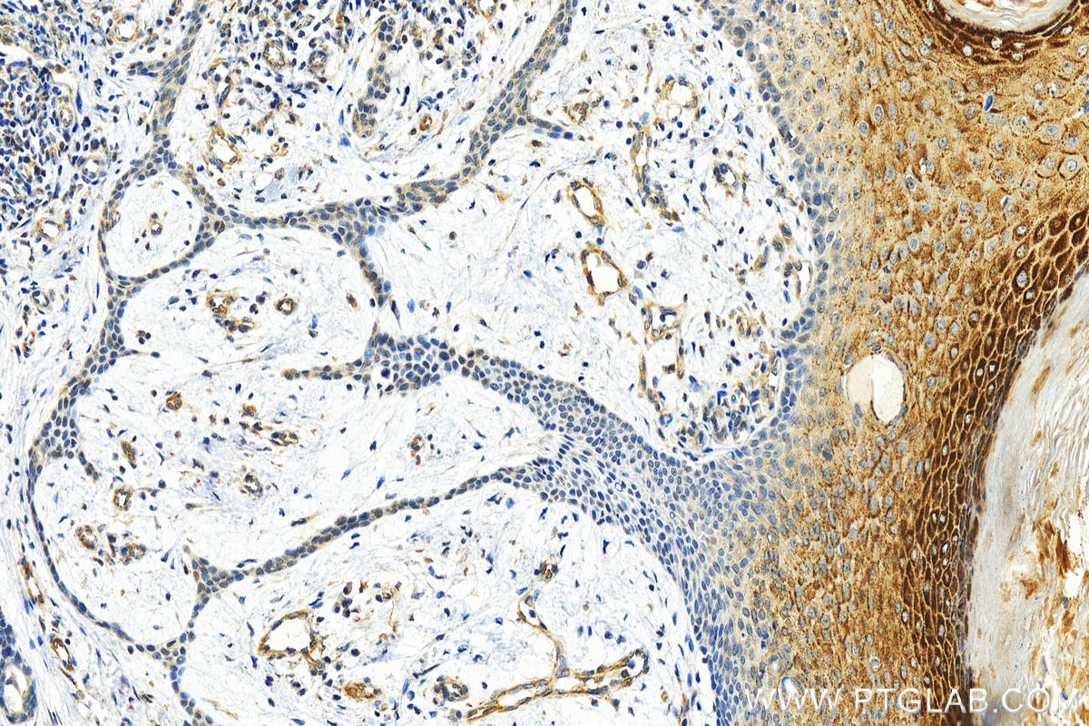 Immunohistochemistry (IHC) staining of human skin cancer tissue using CDC25B Monoclonal antibody (67145-1-Ig)