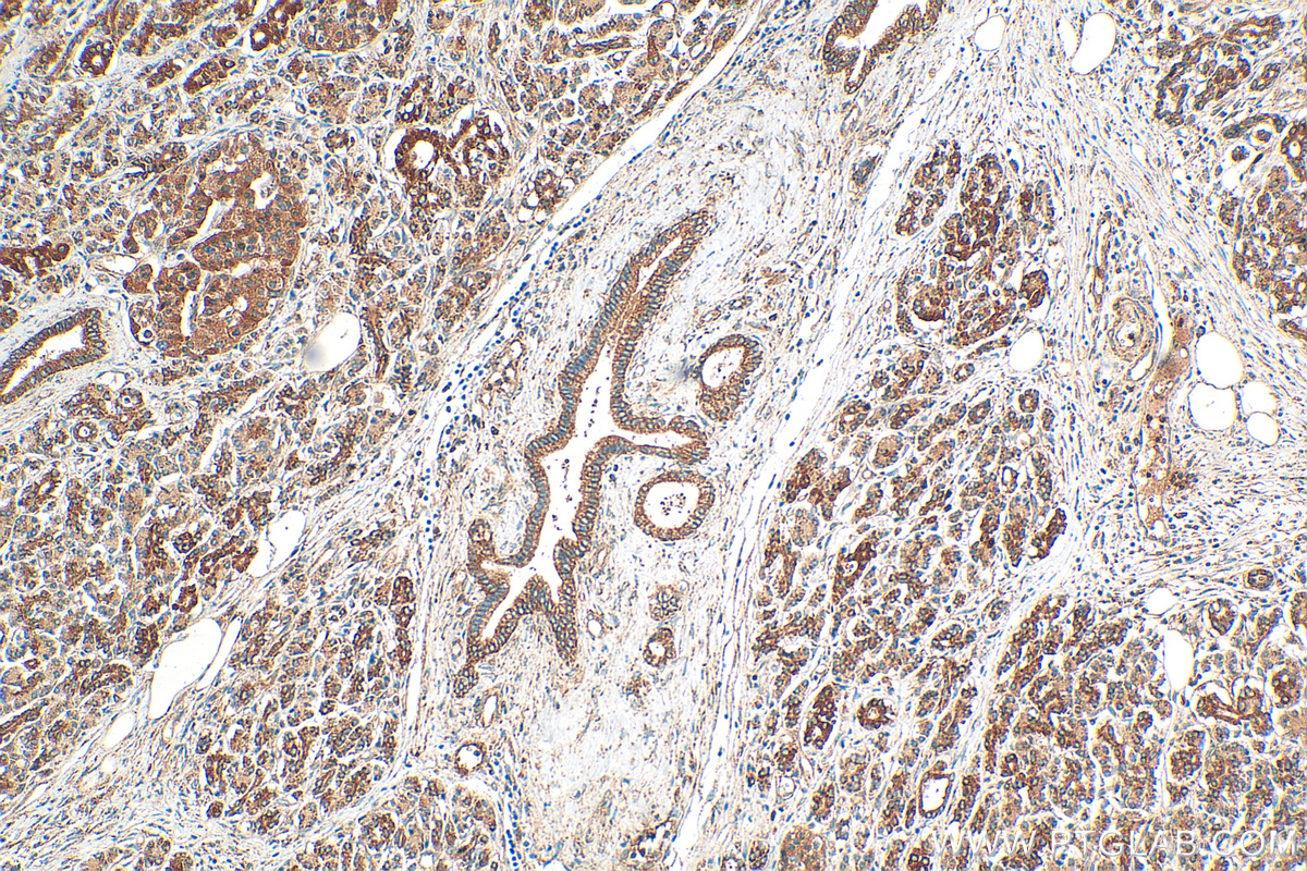 Immunohistochemistry (IHC) staining of human pancreas cancer tissue using CDC42 Polyclonal antibody (10155-1-AP)