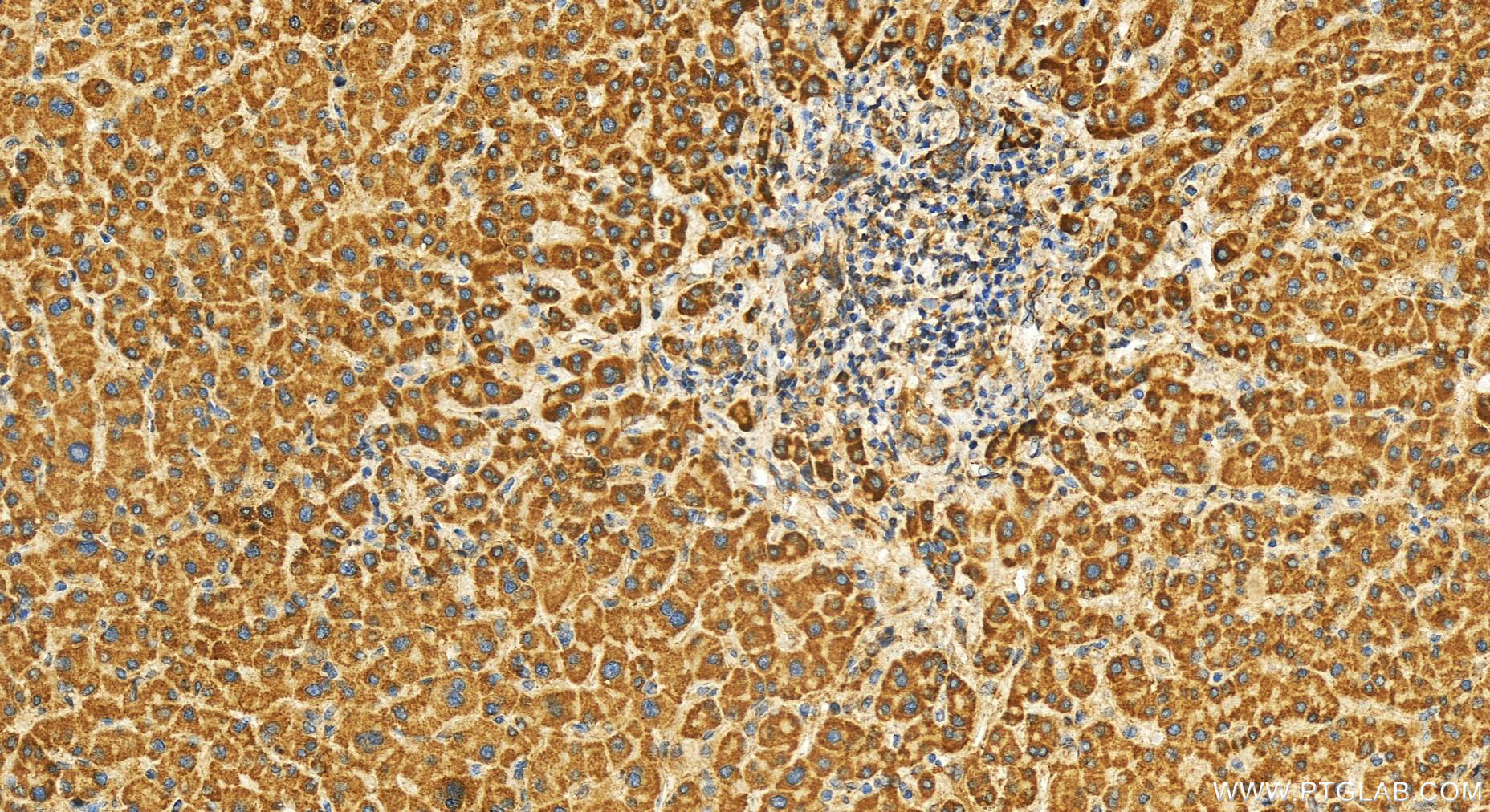 Immunohistochemistry (IHC) staining of human intrahepatic cholangiocarcinoma tissue using CDC42EP4 Polyclonal antibody (19262-1-AP)