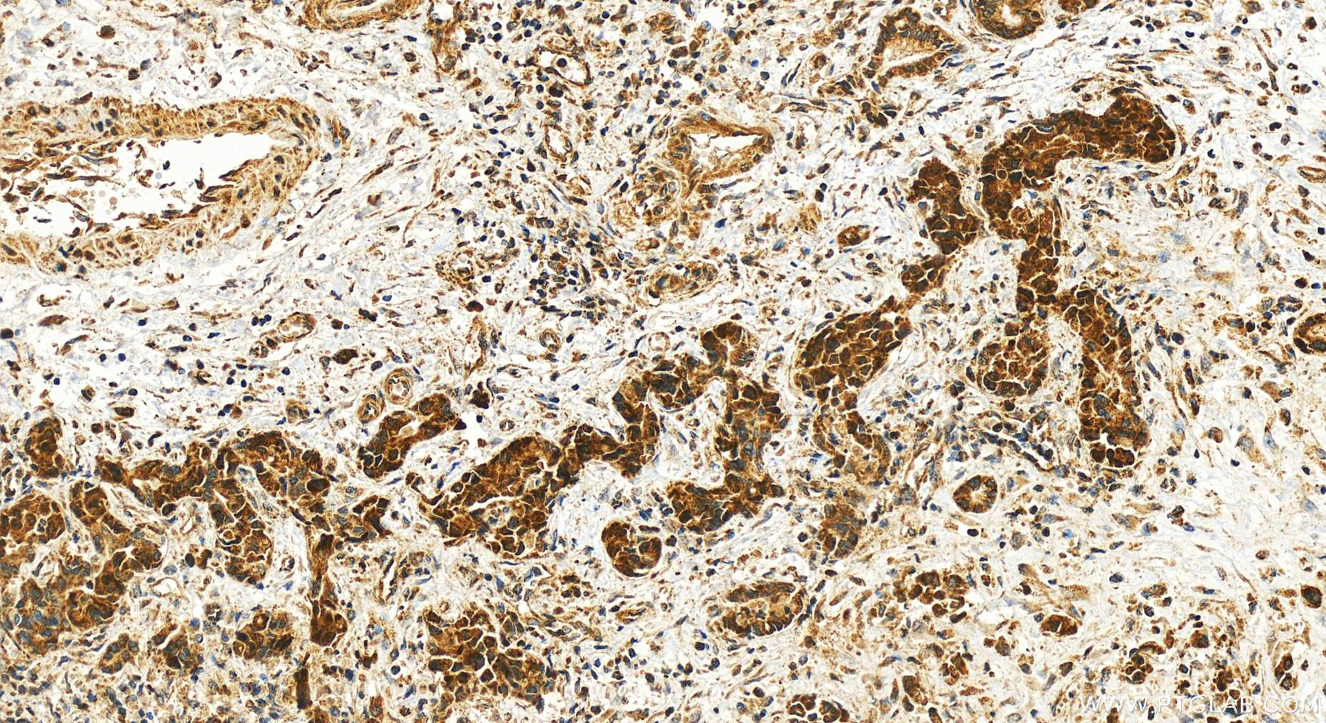 Immunohistochemistry (IHC) staining of human intrahepatic cholangiocarcinoma tissue using CDC42EP4 Polyclonal antibody (19262-1-AP)