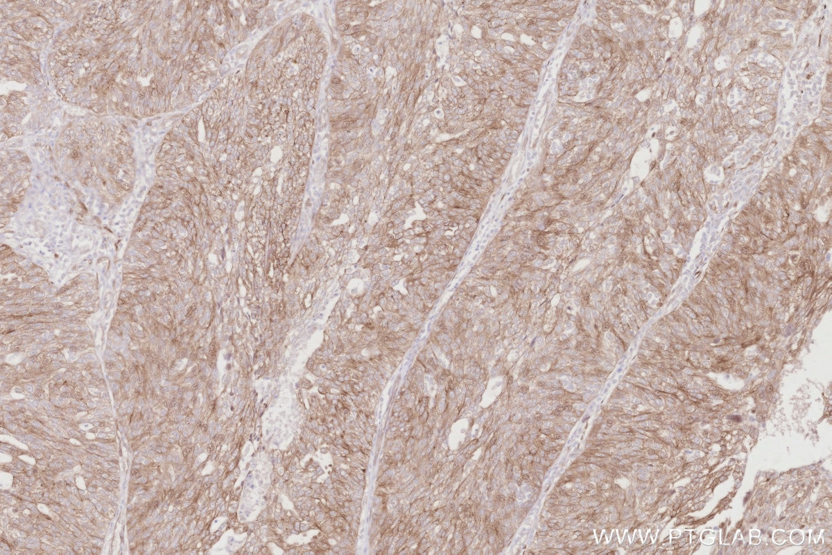 Immunohistochemistry (IHC) staining of human ovary cancer tissue using CDC42EP4 Polyclonal antibody (19262-1-AP)