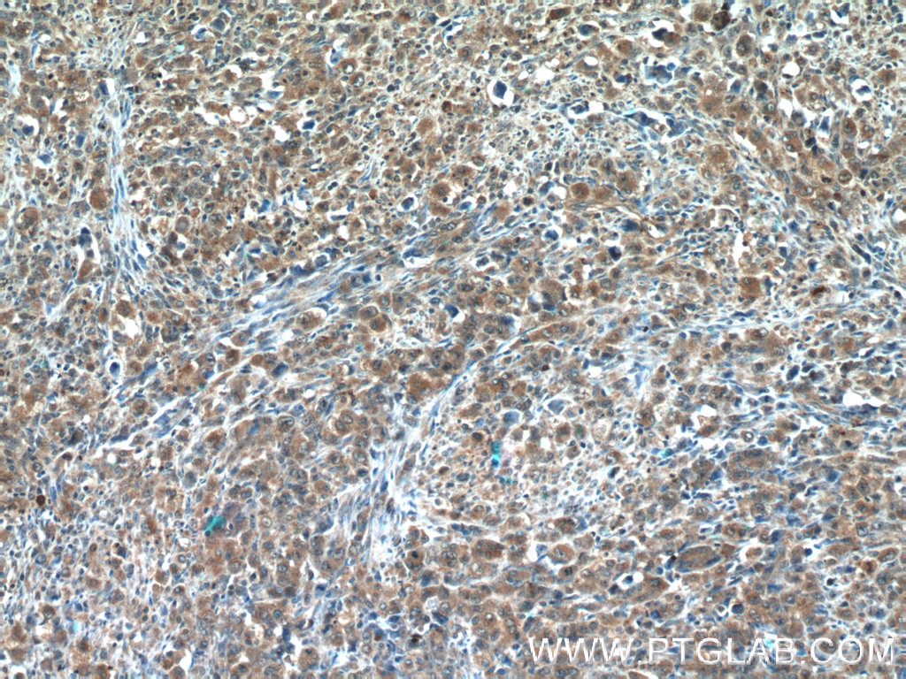 Immunohistochemistry (IHC) staining of human lymphoma tissue using CDC42SE2 Polyclonal antibody (21424-1-AP)