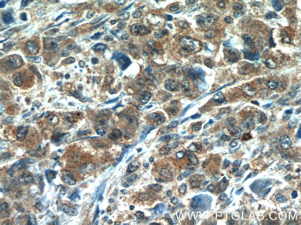 Immunohistochemistry (IHC) staining of human lymphoma tissue using CDC42SE2 Polyclonal antibody (21424-1-AP)