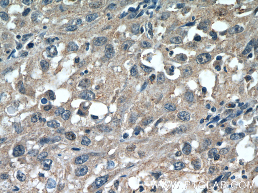 Immunohistochemistry (IHC) staining of human cervical cancer tissue using CDCA3 Polyclonal antibody (15594-1-AP)