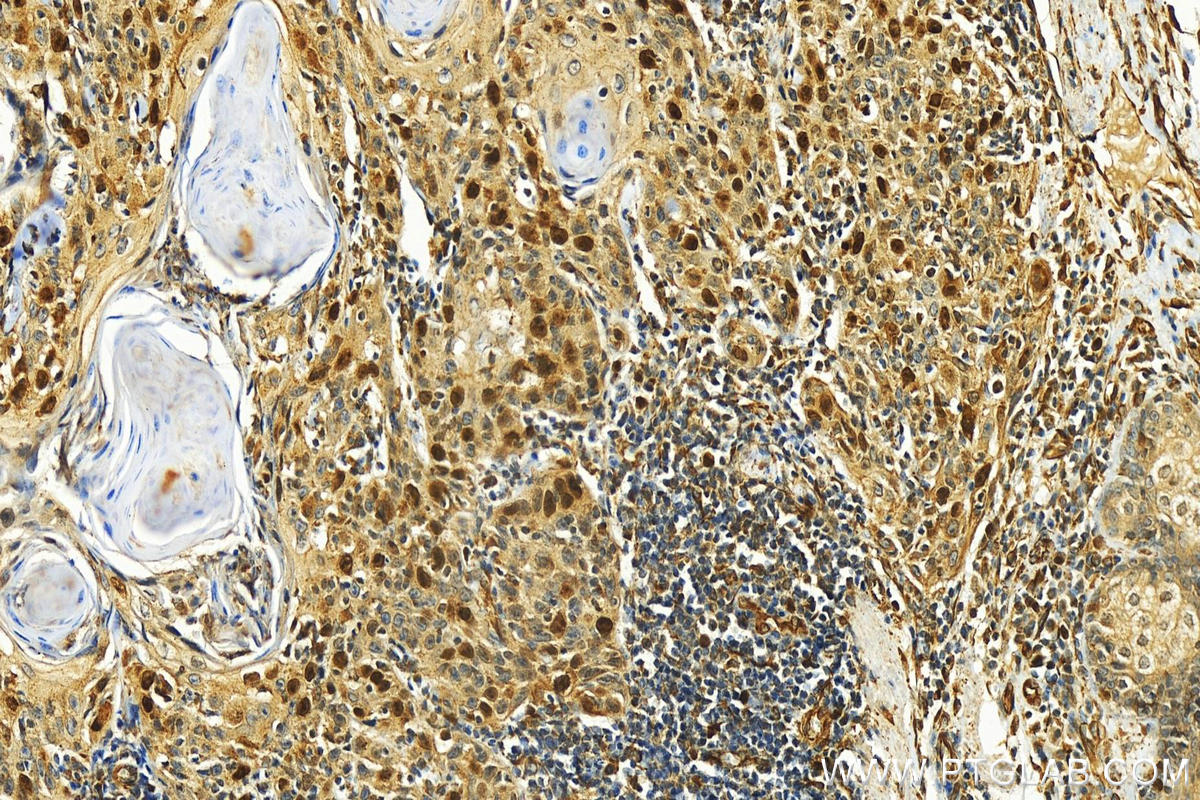 Immunohistochemistry (IHC) staining of human skin cancer tissue using CDCA5 Polyclonal antibody (29316-1-AP)