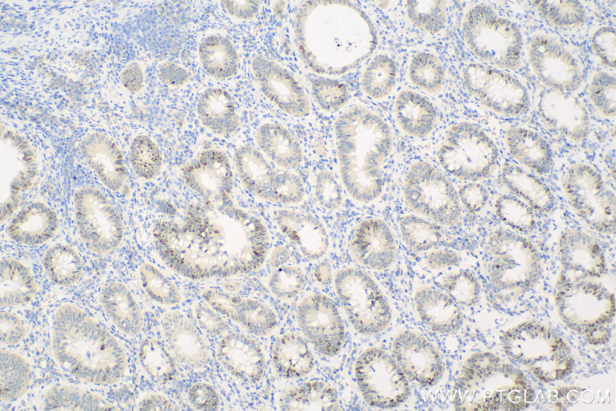 Immunohistochemistry (IHC) staining of human colon cancer tissue using CDCA7 Polyclonal antibody (15249-1-AP)