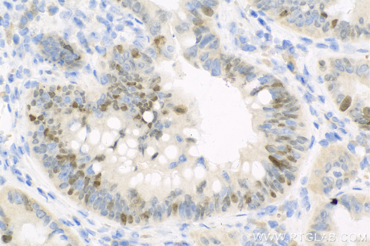 Immunohistochemistry (IHC) staining of human colon cancer tissue using CDCA7 Polyclonal antibody (15249-1-AP)