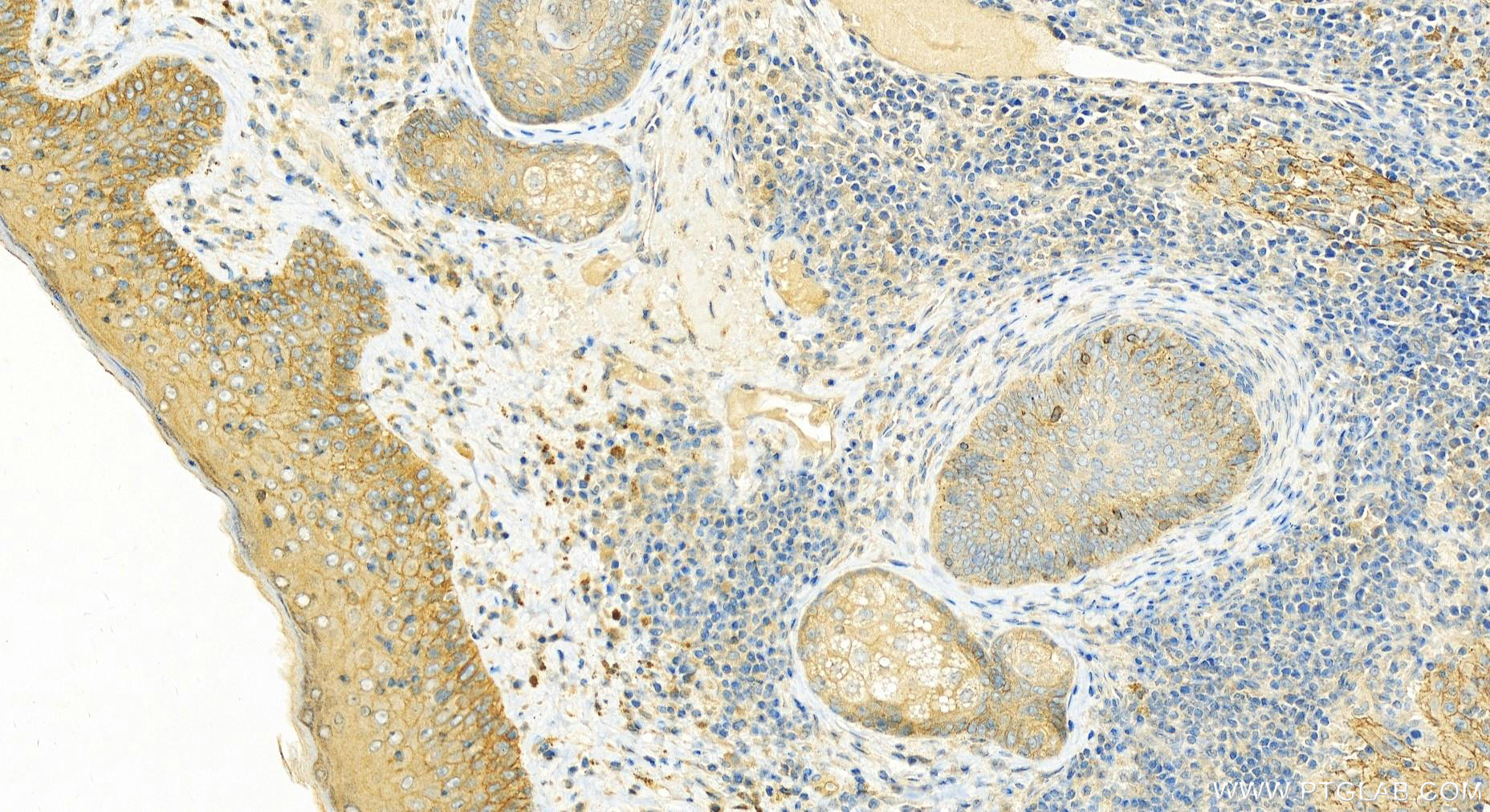 Immunohistochemistry (IHC) staining of human skin cancer tissue using CDCP1 Polyclonal antibody (12754-1-AP)