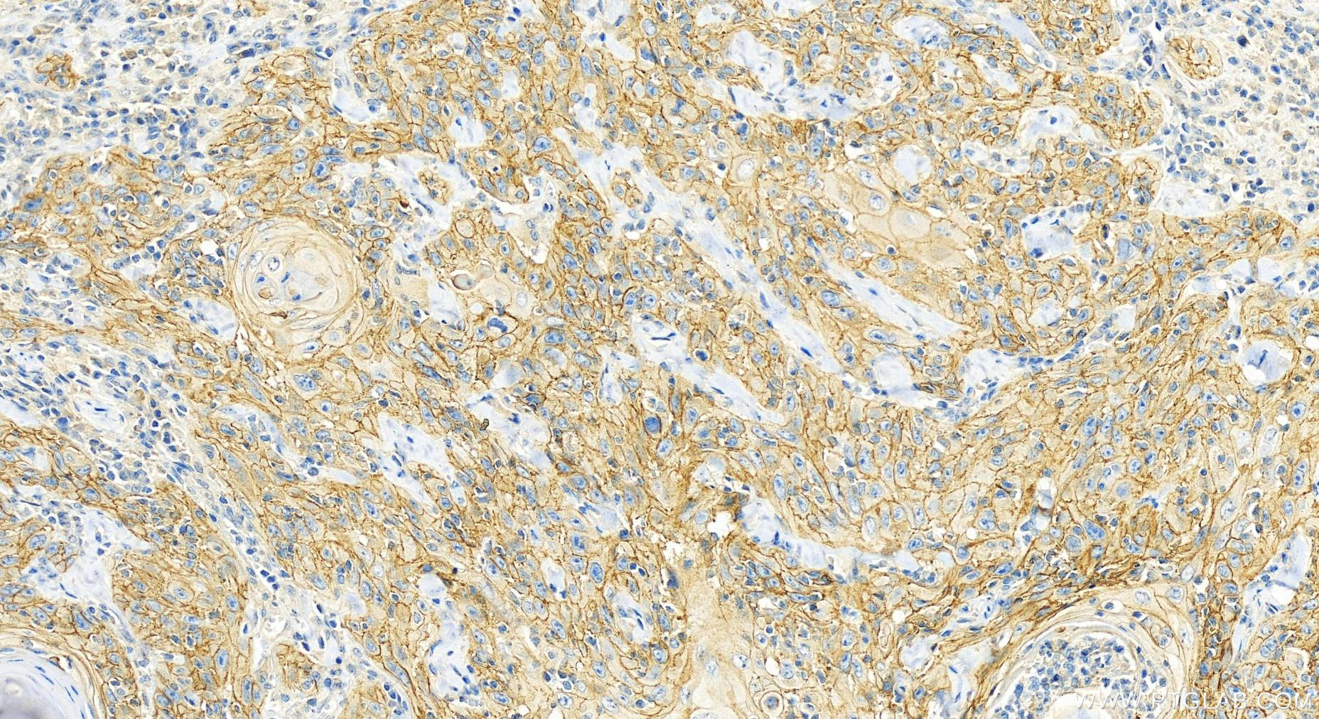 Immunohistochemistry (IHC) staining of human skin cancer tissue using CDCP1 Polyclonal antibody (12754-1-AP)