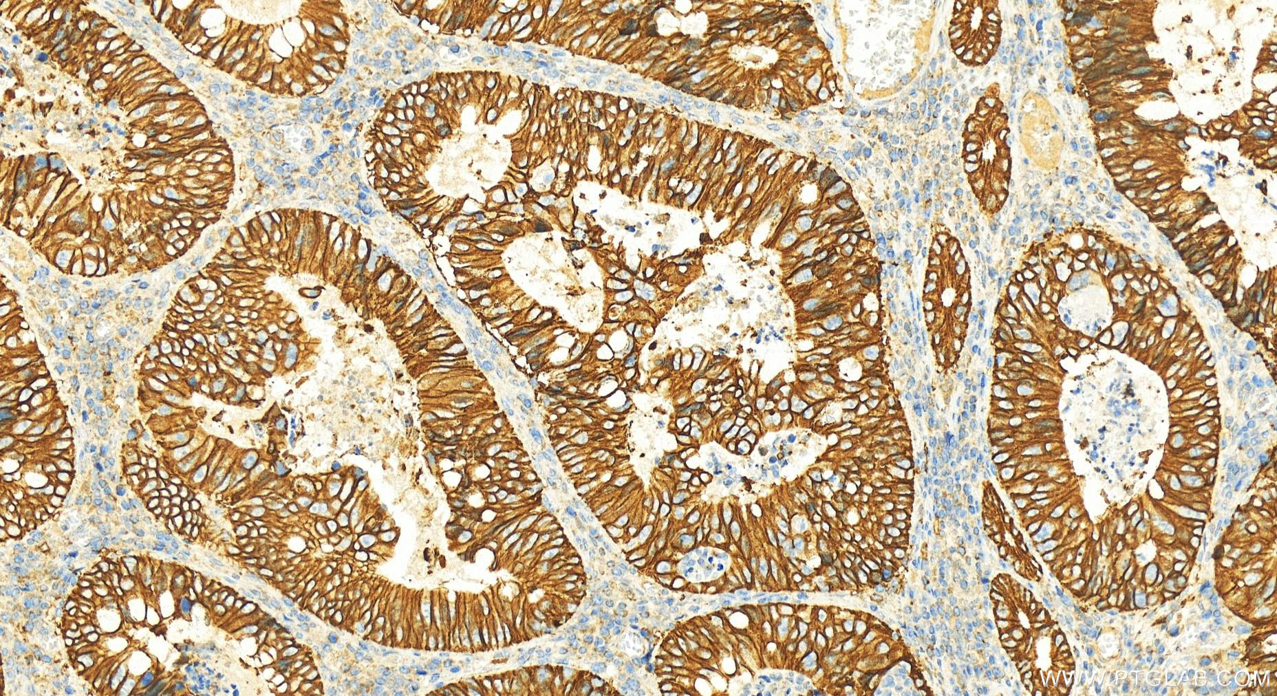 Immunohistochemistry (IHC) staining of colon cancer using Cadherin-17 Polyclonal antibody (24339-1-AP)