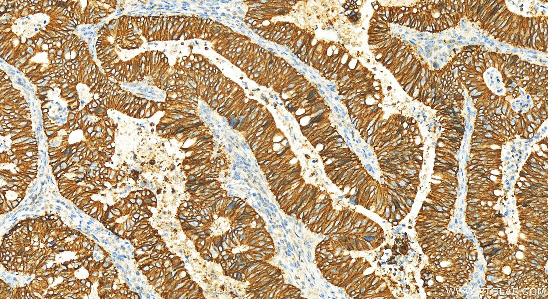 Immunohistochemistry (IHC) staining of colon cancer using Cadherin-17 Polyclonal antibody (24339-1-AP)