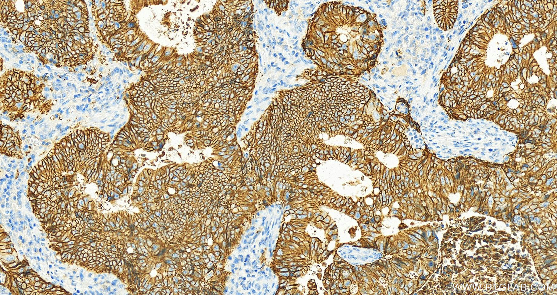 Immunohistochemistry (IHC) staining of human colon cancer tissue using Cadherin-17 Monoclonal antibody (60351-1-Ig)